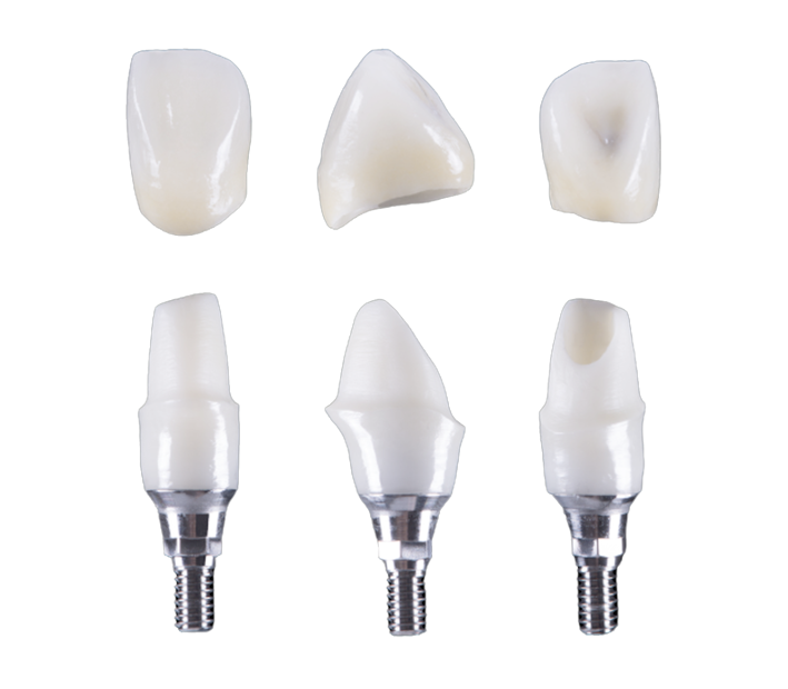 Phục hình răng trên Implant